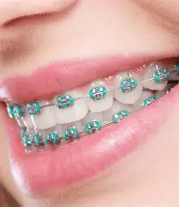 Braces & Orthodontics treatment at Kripa Dental Clinic Bharatpur Chitwan