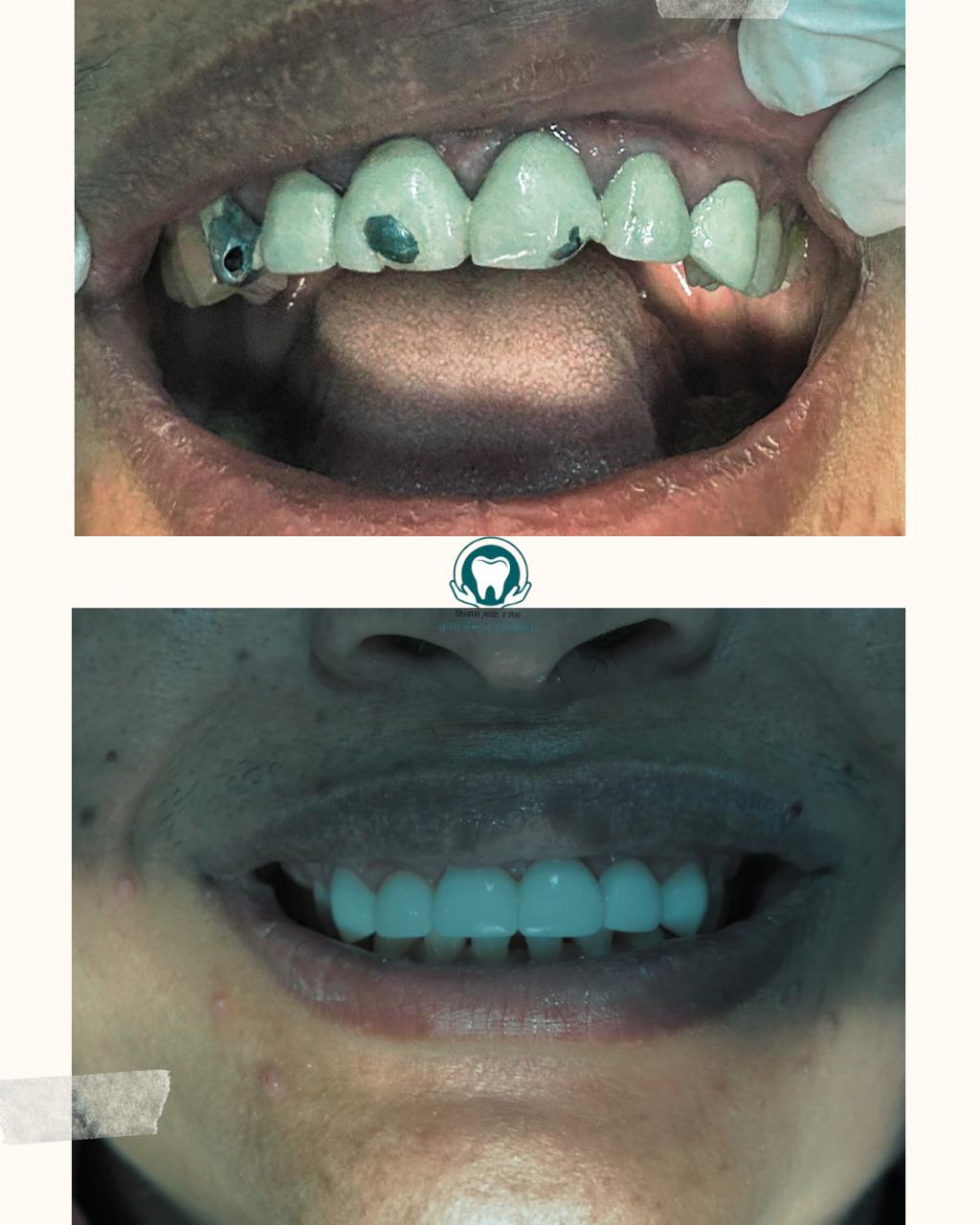 Smile transformation result at Kripa Dental Clinic Bharatpur