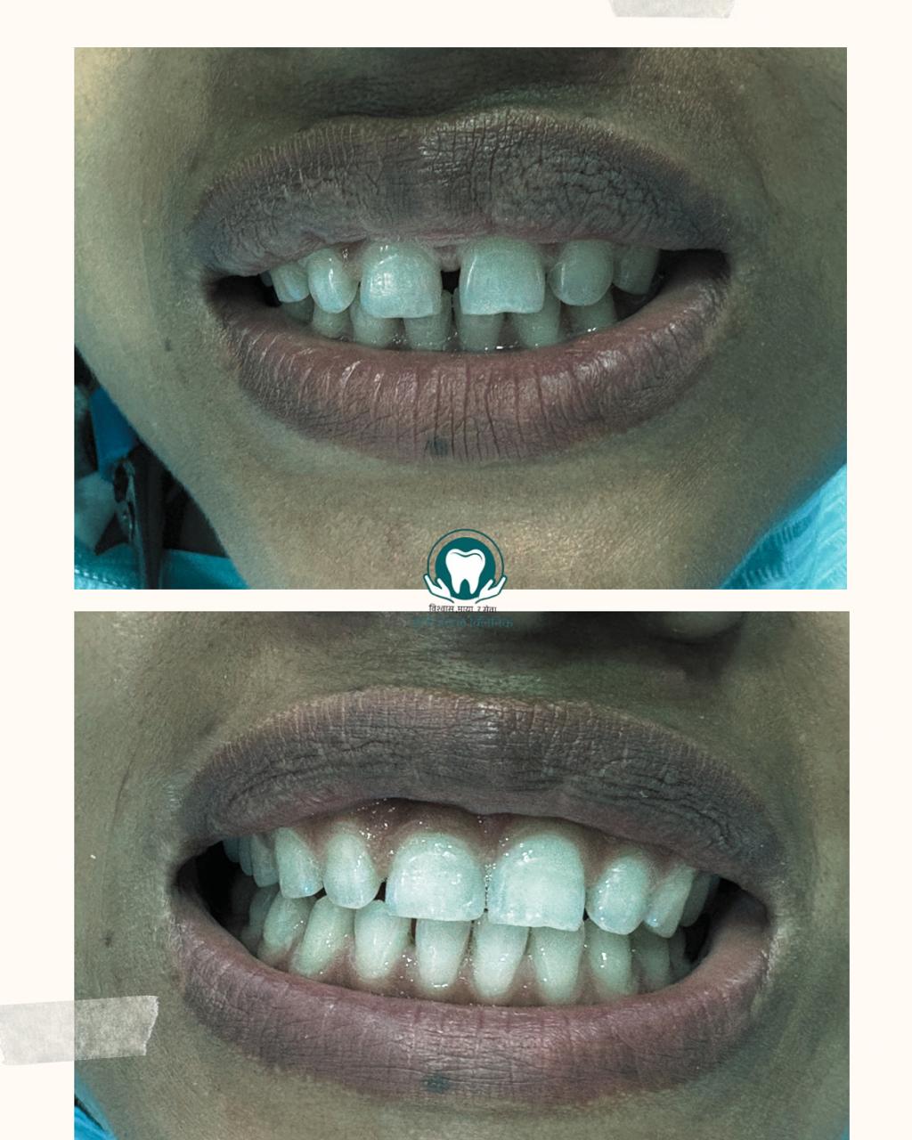 Smile transformation result at Kripa Dental Clinic Bharatpur
